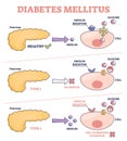 Diabetes mellitus as high blood sugar and metabolic illness outline diagram