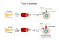Diabetes mellitus type 2, cells fail to respond to insulin, Insulin resistance. high blood glucose levels.