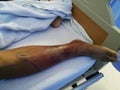 A diabetes patient resting on bed and with the leg swelling and redness symptoms.