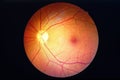 Diabetes retinopathy. Royalty Free Stock Photo