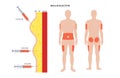 Insulin injection sites