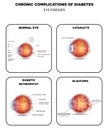 Diabetic Eye Diseases diagram Royalty Free Stock Photo