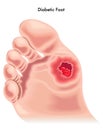 Diabetic foot Royalty Free Stock Photo