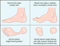 Diabetic foot