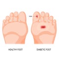 Diabetic foot