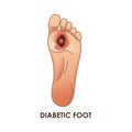 Diabetic Foot. Defeat, ulcer, skin sores on foot