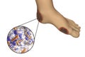 Diabetic foot infection with close-up view of bacteria