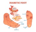 Diabetic foot medical vector illustration scheme. Royalty Free Stock Photo