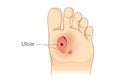 Diabetic Foot Pain and Ulcers.