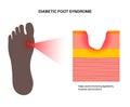 Diabetic Foot Ulcers