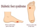 Diabetic foot syndrome