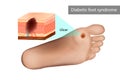 Diabetic foot syndrome ulcer. Destruction of deep tissues of the foot Royalty Free Stock Photo