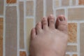 Diabetic foot top view real body.