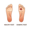 Diabetic and healthy foot. Vector illustration