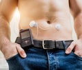 Diabetic man with an insulin pump connected in his abdomen Royalty Free Stock Photo