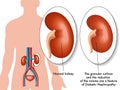 Diabetic nephropathy Royalty Free Stock Photo