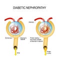 Diabetic nephropathy. diabetic kidney disease Royalty Free Stock Photo