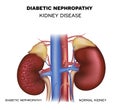 Diabetic Nephropathy, kidney disease Royalty Free Stock Photo