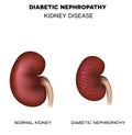 Diabetic Nephropathy, kidney disease Royalty Free Stock Photo