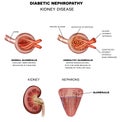 Diabetic Nephropathy, kidney disease Royalty Free Stock Photo