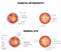 Diabetic retinopathy Royalty Free Stock Photo