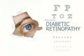 Diabetic retinopathy disease poster with eye test chart and blue eye. Royalty Free Stock Photo