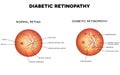 Diabetic retinopathy Royalty Free Stock Photo