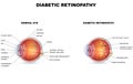 Diabetic retinopathy Royalty Free Stock Photo