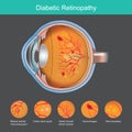 Diabetic Retinopathy. Illustration abnormality the retina from symptoms the diabetic