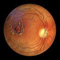 Diabetic retinopathy, ophthalmoscopic diagnosis, illustration