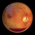 Diabetic retinopathy, ophthalmoscopic diagnosis, illustration