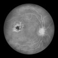 Diabetic retinopathy, ophthalmoscopic diagnosis, illustration