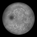 Diabetic retinopathy, ophthalmoscopic diagnosis, illustration