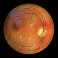 Diabetic retinopathy, ophthalmoscopic diagnosis, illustration