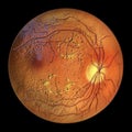 Diabetic retinopathy, ophthalmoscopic diagnosis, illustration