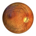 Diabetic retinopathy, ophthalmoscopic diagnosis, illustration