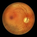 Diabetic retinopathy, ophthalmoscopic diagnosis, illustration