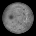 Diabetic retinopathy, ophthalmoscopic diagnosis, illustration