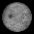 Diabetic retinopathy, ophthalmoscopic diagnosis, illustration