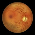 Diabetic retinopathy, ophthalmoscopic diagnosis, illustration