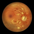 Diabetic retinopathy, ophthalmoscopic diagnosis, illustration