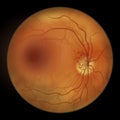 Diabetic retinopathy, ophthalmoscopic diagnosis, illustration