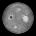 Diabetic retinopathy, ophthalmoscopic diagnosis, illustration