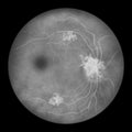 Diabetic retinopathy, ophthalmoscopic diagnosis, illustration