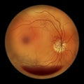 Diabetic retinopathy, ophthalmoscopic diagnosis, illustration