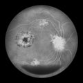 Diabetic retinopathy, ophthalmoscopic diagnosis, illustration