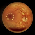 Diabetic retinopathy, ophthalmoscopic diagnosis, illustration