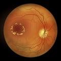 Diabetic retinopathy, ophthalmoscopic diagnosis, illustration