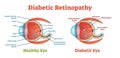 Diabetic Retinopathy vector illustration diagram, anatomical scheme. Royalty Free Stock Photo