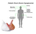 Diabetic Shock (Severe Hypoglycemia